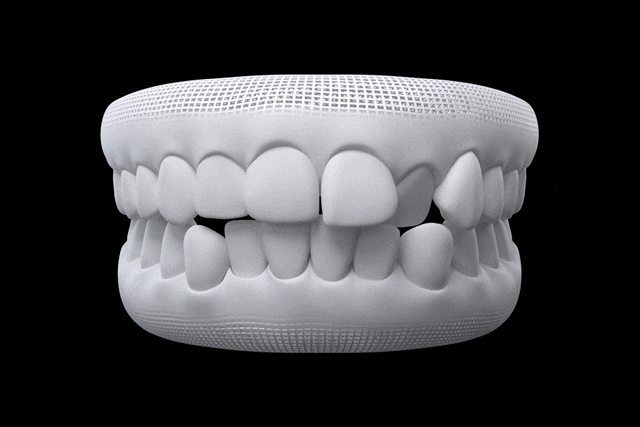 Invisalign_anwendung